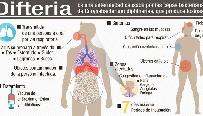 difteria