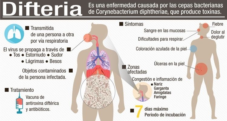 difteria